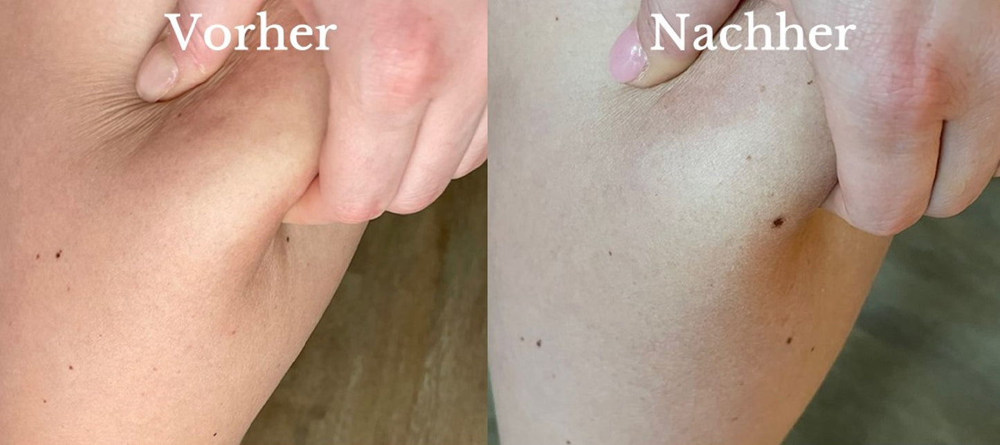 Derma Power Lipolysis