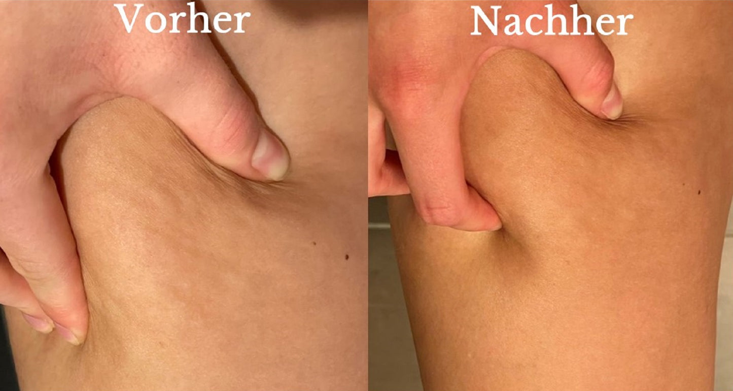 Derma Power Lipolysis