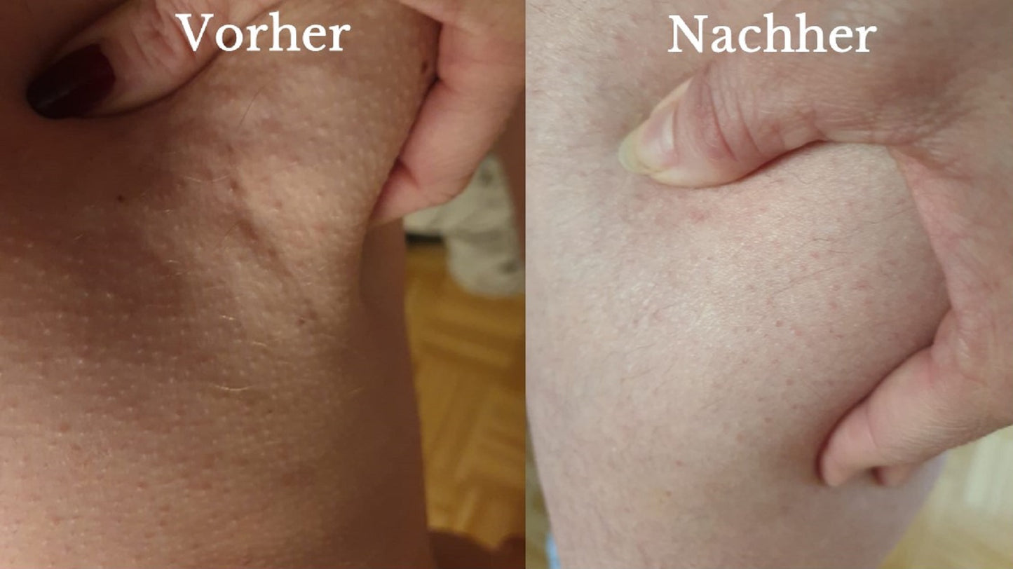 Derma Power Lipolysis