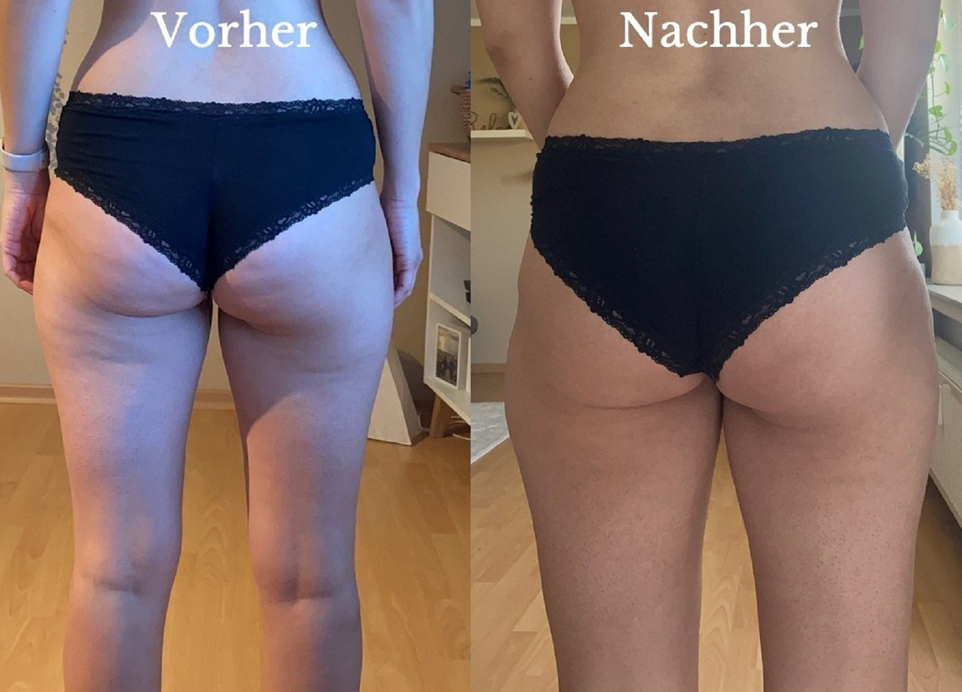 Derma Power Lipolysis